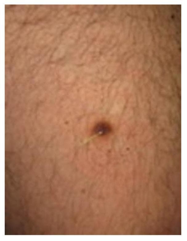 Clinical photograph of a solitary dermatofibroma (DF) presenting as a dark brown to black, well-circumscribed, firm nodule on the skin. A key diagnostic feature illustrated is the 'Meyerson phenomenon', characterized by an inflammatory, eczematous-like reaction or halo surrounding the fibrous lesion, often visible as a lighter or erythematous ring. The primary lesion is centrally located within the image and features a terminal hair protruding from the nodule, a common finding in benign skin lesions. The surrounding skin exhibits a light brown tone with visible hair follicles and several smaller, non-specific melanocytic nevi scattered in the periphery. This image serves as an educational example of clinical variations of dermatofibroma and the associated Meyerson phenomenon, relevant for dermatology residents and medical students studying pigmented skin tumors.