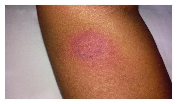 Clinical photograph of a forearm demonstrating a strongly positive Mantoux tuberculin skin test (TST). The visual finding consists of a significant area of induration and erythema. Centrally, the skin is visibly raised with a slightly irregular, 'orange-peel' (peau d'orange) texture, suggesting a potent delayed-type hypersensitivity reaction. The indurated area is circumscribed by a dark blue circular ink marking, used clinically to facilitate the measurement of the wheal. The surrounding skin is of a moderate tone with visible hair follicles and no evidence of generalized rash. This reaction measures approximately 25 mm in diameter, indicating exposure to Mycobacterium tuberculosis or related mycobacteria. The image serves as a teaching tool for recognizing high-degree induration associated with systemic tuberculosis infections, such as dural tuberculosis.