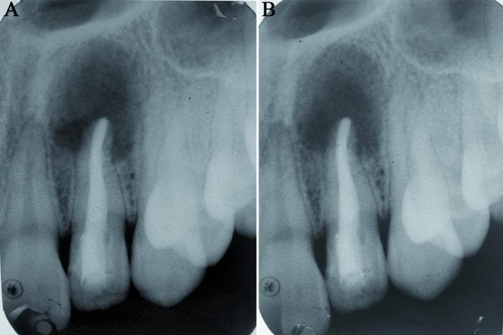 Two side-by-side intraoral periapical (IOPA) radiographs (A and B) demonstrate the post-surgical healing of a large periapical lesion in the maxillary anterior region. The central focus is a maxillary lateral incisor that has undergone endodontic treatment, evidenced by a dense, uniform radiopaque root canal filling extending to the apex. Radiograph A, representing a 6-week follow-up, shows a significant, well-defined radiolucent area surrounding the root apex, indicative of a persistent bony defect following the enucleation of a radicular cyst. Radiograph B, at a 12-week follow-up, illustrates progressive bone regeneration. The previously dark radiolucent area exhibits increased radiographic density, with a visible trabecular bone pattern filling the defect from the periphery toward the center. This comparison highlights the typical timeline and radiographic appearance of successful bone healing and apical tissue repair after surgical intervention and root canal therapy. The surrounding alveolar bone and adjacent teeth remain stable throughout the observation period.
