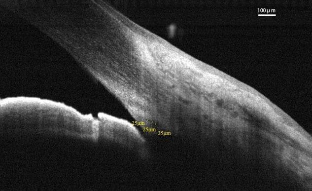 This diagnostic image is an Optical Coherence Tomography (OCT) cross-section of the human anterior segment of the eye, specifically focusing on the iridocorneal angle. The image demonstrates the anatomical relationship between the peripheral cornea, limbus, and iris. Centrally, the iridocorneal angle is visible, showing the trabecular meshwork and Schlemm’s canal (SC). Schlemm’s canal is identified as a low-reflectivity (hyporeflective) elliptical structure within the limbal sclera. Yellow quantitative annotations indicate measurements of 25µm and 35µm, representing the cross-sectional area (CSA) or dimensions of Schlemm’s canal and its proximity to the angle recess. A 100µm scale bar is provided in the upper right for spatial reference. This imaging modality is critical for evaluating aqueous humor outflow pathways in ophthalmology, particularly in the management of glaucoma and assessing surgical outcomes of micro-invasive glaucoma surgery (MIGS).