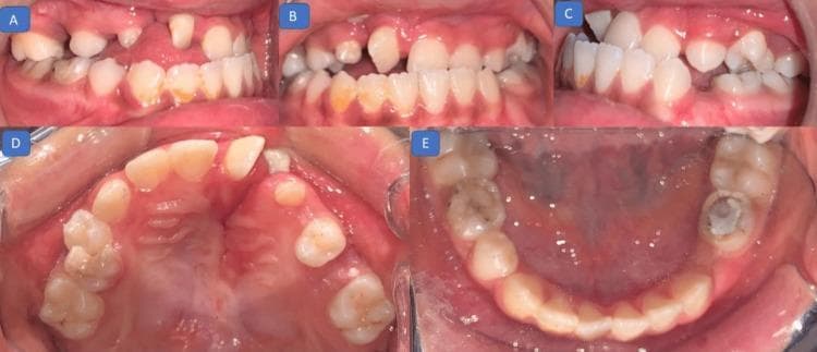 A composite of five intraoral clinical photographs documenting pretreatment dental status in a pediatric patient with a history of cleft lip and palate. (A, C) Right lateral views demonstrate an Angle Class III molar relationship, characterized by the mandibular teeth being mesial to the maxillary teeth, and a missing deciduous first molar. (B) Frontal view reveals a negative overjet (anterior crossbite), with maxillary incisors positioned lingual to the mandibular incisors. (D) Maxillary occlusal view shows a rotated right central incisor and a significant discontinuity of the alveolar ridge on the right side, consistent with a cleft defect. (E) Mandibular occlusal view shows a well-aligned arch with a large restoration and discoloration on the distal-most lower right tooth. The images illustrate malocclusion and anatomical discrepancies typical of orofacial cleft sequelae, including dental rotations, spacing, and skeletal Class III disharmony.