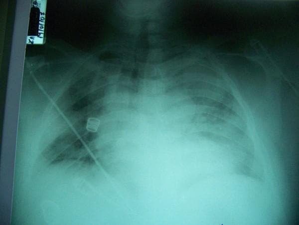 This diagnostic image is an anteroposterior (AP) chest x-ray demonstrating clinical features consistent with Acute Respiratory Distress Syndrome (ARDS). The radiograph reveals diffuse, bilateral pulmonary infiltrates with extensive alveolar opacities and increased density in both lung fields, appearing as a 'white-out' effect that obscures the normal bronchovascular markings. The distribution is patchy and widespread, affecting both central and peripheral regions, indicative of non-cardiogenic pulmonary edema or severe inflammatory consolidation. A prominent medical device is visible: a catheter or pulmonary artery line enters from the left upper thoracic region, traversing diagonally across the right lung field, featuring a distinct coiled (pigtail) component. The image illustrates the radiographic progression of respiratory failure in the context of critical care management, such as that seen in severe pneumonia or systemic inflammatory responses like the Jarisch-Herxheimer reaction.