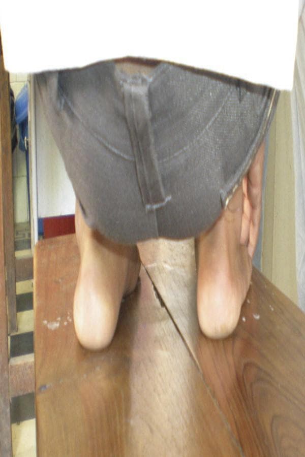 This clinical photograph provides a posterior view of a pediatric patient's lower extremities, specifically focusing on the feet and ankles. The image documents the morphological outcome of bilateral clubfoot (talipes equinovarus) at a five-year follow-up following treatment, potentially via the Ponseti method. Visually, both heels exhibit a mild residual varus deformity, characterized by an inward tilting of the calcaneus relative to the tibia. There is evidence of forefoot adduction, where the distal portion of the feet deviates toward the midline. The patient is shown in a weight-bearing or functional stance on a wooden surface, which helps assess the alignment of the hindfoot and midfoot. This image is clinically relevant for orthopedists and physical therapists evaluating long-term corrective outcomes, assessing for recurrence of equinus, varus, or adductus components of clubfoot, and determining the necessity for further orthotic intervention or maintenance such as the Denis-Browne splint.