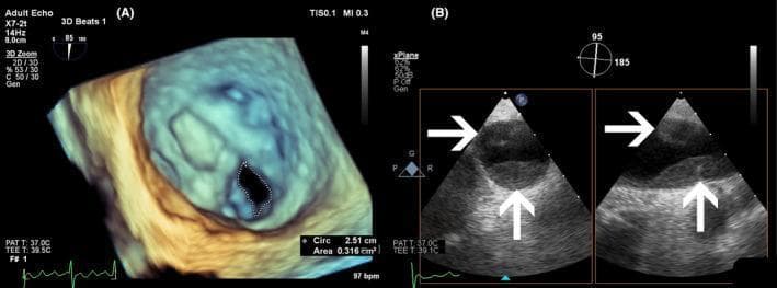 This composite diagnostic image showcases transesophageal echocardiography (TEE) findings in a patient with multi-valvular and vascular pathology. Image (A) presents a three-dimensional (3D) TEE volume rendering of the mitral valve viewed from the left atrium ('surgical view'). It demonstrates severe mitral stenosis (MS), characterized by thickened valve leaflets and a significantly restricted orifice. A dotted white line highlights the planimetered mitral valve area (MVA), measured at 0.316 cm², indicating critical stenosis. Image (B) displays a dual-panel X-plane TEE view of the pulmonary artery. White arrows indicate large, hyperechoic, obstructive masses within the proximal part of the right pulmonary artery, diagnostic of pulmonary thromboembolism (PTE). The educational focus of this visual is the use of advanced echocardiographic modalities, such as 3D rendering and X-plane imaging, to evaluate structural heart disease and associated vascular complications like pulmonary hypertension and thrombosis. The content is highly relevant for cardiology and radiology residents studying valvular hemodynamics and embolic phenomena.
