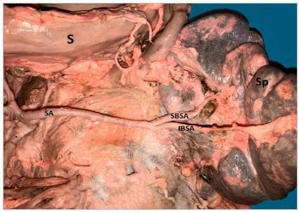 This clinical photograph from a surgical or cadaveric dissection displays the abdominal anatomy focusing on the vascular supply to the spleen. The image illustrates a splenic artery (SA) with a linear, straight trajectory, contrasting with more common tortuous presentations. The artery is shown passing inferiorly and posteriorly to the stomach (S). As the splenic artery approaches the splenic hilum, it undergoes a primary terminal bifurcation into two major vessels: the Superior Branch Splenic Artery (SBSA) and the Inferior Branch Splenic Artery (IBSA). The spleen (Sp) is visible at the distal end of the vascular trajectory. The dissection highlights the topographical relationship between the celiac trunk branches and the visceral organs, providing educational value for surgical planning in procedures such as splenectomy or distal pancreatectomy. The clear visualization of the branching pattern serves as an anatomical reference for variations in splenic arterial morphology and their respective supply zones within the splenic parenchyma.