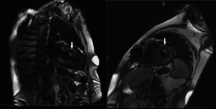Diagnostic Imaging: Gadolinium-enhanced cardiac MRI (late gadolinium enhancement - LGE) presenting two views of the heart: a long-axis view (left) and a short-axis cross-section (right). The images demonstrate a hallmark diagnostic pattern of cardiac amyloidosis. Specifically, there is diffuse, heterogeneous, and circumferential subendocardial enhancement involving the entire left ventricle. White arrows highlight areas where this pathological enhancement extends significantly into the myocardium, occupying at least 50% of the myocardial thickness. This pattern is indicative of extensive infiltrative cardiomyopathy, most commonly associated with AL (light chain) amyloidosis. The visualization emphasizes the loss of the normal myocardial nulling and the presence of transmural extension of the amyloid deposits within the left ventricular wall.