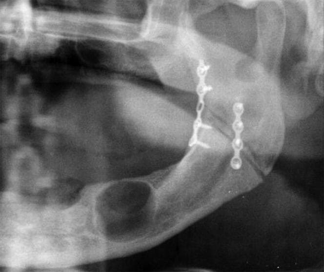 This diagnostic image is a cropped view of a panoramic dental X-ray (orthopantomogram) focusing on the left mandible. The radiograph reveals metallic osteosynthesis hardware used for internal fixation of a mandibular fracture at the left angle and ascending ramus. Two distinct, relatively straight mini-plates are visible: a superior/posterior plate with four holes secured by four screws, and an inferior/anterior plate with five holes secured by five screws. Parallel to this hardware, a significant pathological finding is noted in the inferior body of the mandible: a well-circumscribed, oval-shaped radiolucent lesion with smooth borders, consistent with a mandibular cyst. The surrounding bone shows varying radiodensity, and the jaw appears edentulous. This visual is significant for oral and maxillofacial surgery and forensic odontology, illustrating both post-surgical trauma management (open reduction and internal fixation) and concurrent intraosseous pathology.