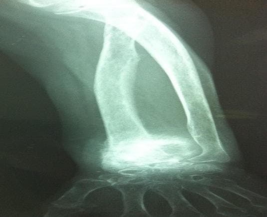 A standard anterior-posterior (AP) radiograph of the left wrist and forearm demonstrating a significant pathological process at the distal radius. The image shows extensive osteolysis of the distal radial metaphysis and epiphysis, characterized by a loss of bone density and a permeative, lucent appearance. The normal cortical contour is disrupted, exhibiting irregular and indistinct borders suggestive of bone destruction and aggressive soft tissue involvement. The distal ulna appears relatively spared compared to the radius, though localized demineralization is visible. The carpal bones and proximal metacarpals are partially visualized and maintain gross anatomical alignment despite the adjacent expansive lesion. This diagnostic image illustrates a secondary bone tumor (metastasis), typically associated with primary malignancies such as rectal adenocarcinoma. Key educational features include the radiographic presentation of malignant osteolysis, loss of structural integrity in the distal forearm, and signs of aggressive local invasion.