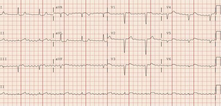 This diagnostic image is a 12-lead electrocardiogram (ECG) featuring leads I, II, III, aVR, aVL, aVF, and V1-V6. The rhythm strips demonstrate a classic presentation of atrial fibrillation characterized by the total absence of discrete P waves and the presence of irregular fibrillatory (f) waves best seen in lead V1 and the rhythm strip of lead II. Notably, there is rate regularization, where the R-R intervals are consistent and regular despite the underlying atrial chaos. This combination of atrial fibrillation with a regular ventricular response is highly suggestive of high-grade or complete atrioventricular (AV) block, indicating that the ventricles are being paced by an independent junctional or ventricular escape rhythm. The QRS complexes appear relatively narrow, suggesting a high junctional escape origin. No significant ST-segment elevations or T-wave inversions are visualized across the precordial or limb leads. This ECG serves as a critical educational example of how a regular rhythm in the setting of atrial fibrillation indicates advanced conduction system disease.
