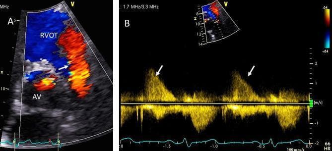 Transthoracic echocardiogram (TTE) demonstrating severe pulmonic regurgitation (PR). Panel A shows a basal short-axis view with color Doppler; the aortic valve (AV) is seen in cross-section, and the pulmonic valve is in long-axis. A wide, predominantly red diastolic regurgitant jet (white arrow) originates at the pulmonic valve and fills greater than 60% of the right ventricular outflow tract (RVOT) width, a key indicator of severity. Panel B displays the corresponding continuous wave (CW) Doppler signal. The PR envelope is characterized by high density and a rapid deceleration (steep slope) of the velocity back to the baseline. The signal terminates prematurely before the onset of the next cardiac cycle, reflecting rapid pressure equalization between the pulmonary artery and the right ventricle in diastole. These findings are diagnostic of hemodynamically significant, severe pulmonic valve regurgitation.