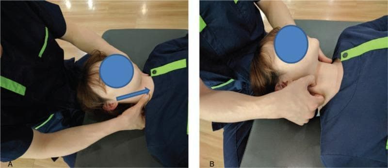 This procedural clinical photograph demonstrates two manual therapy techniques for Soft Tissue Release (SSTR) of the sternocleidomastoid (SCM) muscle. The subject is positioned supine on a treatment table with the head rotated away from the side being treated. Panel A illustrates the 'stripping technique,' where the therapist stabilizes the head with the left hand while using the thumb or finger of the right hand to apply deep longitudinal pressure along the SCM muscle belly. An overlaid blue arrow indicates a cranial-to-caudal (superior-to-inferior) stroke direction, moving from the mastoid process toward the sternum. Panel B demonstrates the 'pincer compression technique,' showing the therapist utilizing a pincer grasp with the thumb and index finger to compress and manipulate the soft tissue of the SCM muscle to address myofascial trigger points or taut bands. These physical therapy interventions are typically used to treat neck pain, reduce muscle hardness, and improve range of motion. The images emphasize proper hand placement and ergonomic positioning for manual soft tissue mobilization in clinical rehabilitation.