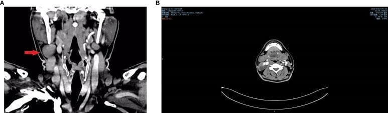 Contrast-enhanced CT scan of the neck presented in coronal (A) and horizontal/axial (B) views. The images demonstrate a well-defined, heterogeneous solid-cystic mass located in the right lateral neck (Level II/III). In the coronal view, the lesion is indicated by a red arrow, positioned lateral to the carotid sheath and posterior-lateral to the thyroid gland. The axial view confirms the mass's position lateral to the trachea and deep to the sternocleidomastoid muscle. Internal features include areas of low attenuation representing cystic components and hyperdense foci consistent with calcification. There is no evidence of significant tracheal deviation or invasion of the adjacent major cervical vasculature. Bilateral small cervical lymph nodes are also visible. This imaging is characteristic of secondary pathologies such as branchial cleft cysts or metastatic papillary thyroid carcinoma with cystic changes. The educational focus is on identifying regional neck masses, their anatomical relationships to the carotid sheath, and recognizing heterogeneous cystic-solid internal morphology on diagnostic radiology.