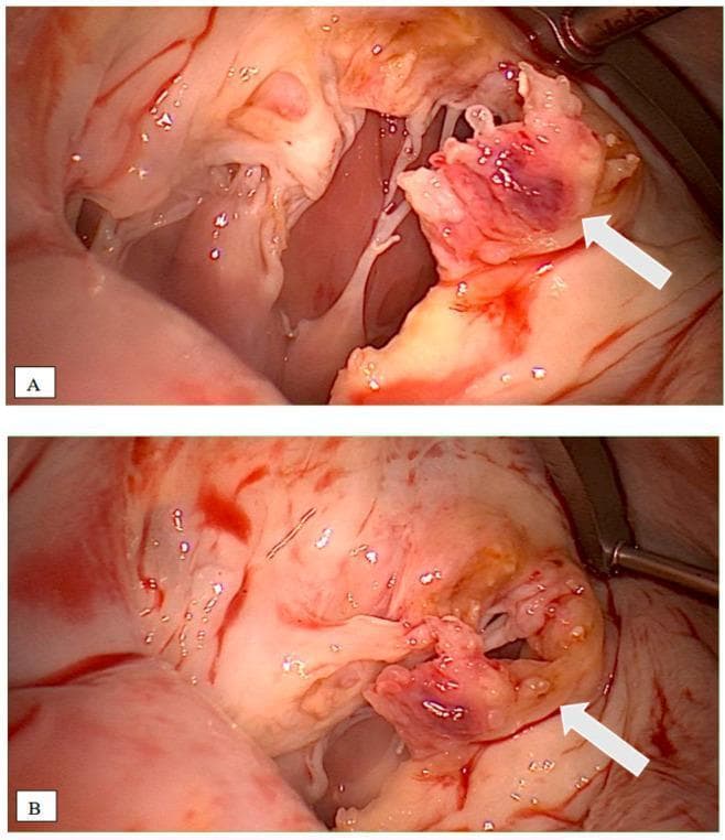 Two intraoperative clinical photographs (labeled A and B) demonstrating the gross pathology of infective endocarditis (IE) on the mitral valve. White arrows indicate large, friable, irregular vegetations attached to the valve leaflets. These vegetations exhibit a classic cauliflower-like morphology with a mottled appearance, featuring light tan tissue interspersed with dark reddish-purple areas suggestive of hemorrhage or focal necrosis. The surrounding mitral valve anatomy shows significant inflammatory disruption, including thickening of the leaflets and involvement of the subvalvular apparatus. These images illustrate the surgical presentation of destructive infective endocarditis, often associated with pathogens like Coxiella burnetii or Streptococcus gordonii, necessitating valve replacement. The clinical relevance highlights the transition from transesophageal echocardiography (TEE) findings to direct surgical visualization for assessing the extent of tissue destruction.