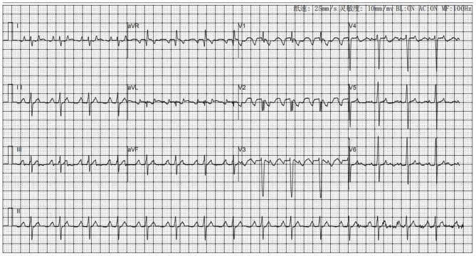 This diagnostic image is a standard 12-lead electrocardiogram (ECG) demonstrating focal atrial tachycardia with variable atrioventricular (AV) conduction. The tracing shows a rapid, regular atrial rate characterized by distinctive P-wave morphologies: notably negative P waves in lead V1 and prominent, positive, 'towering' P waves in the inferior leads (II, III, and aVF). This specific P-wave axis suggests an ectopic atrial origin, such as the right atrial appendage. The ventricular response is irregular, appearing as 2:1 and 1:1 conduction patterns at various intervals. The QRS complexes maintain a narrow morphology (normal duration) with preserved R-wave progression across the precordial leads (V1-V6), indicating that ventricular depolarization follows the normal specialized conduction system once activated. No periods of normal sinus rhythm are observed. The tracing is typical for pediatric or adult patients presenting with supraventricular tachycardia-induced cardiomyopathy or persistent palpitations, serving as a key diagnostic tool for identifying the site of origin prior to electrophysiological mapping and ablation.