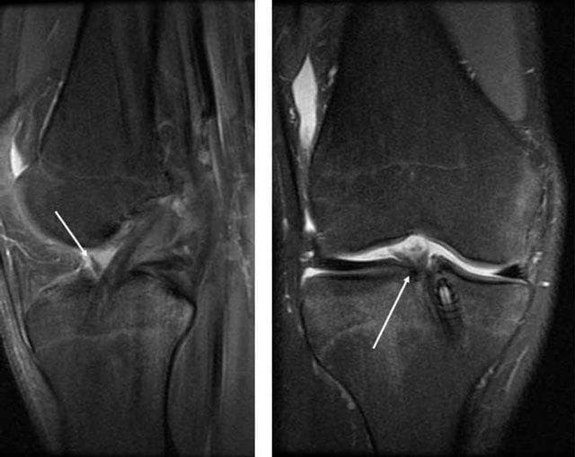 Diagnostic Image: Two T2-weighted MRI scans of the knee joint in sagittal (left) and coronal (right) planes, illustrating a partial rupture of an anterior cruciate ligament (ACL) graft. In the sagittal view, the anterior portion of the ACL graft exhibits a localized region of increased signal intensity (hyperintensity) and visible fiber discontinuity, indicated by a white arrow, suggesting a focal tear or fluid accumulation within the ligament. The coronal view demonstrates similar findings, with an arrow pointing to a high-signal area in the anterior-medial aspect of the graft, reflecting edema or intrasubstance disruption. These radiological features differentiate a partial rupture from a normal graft, which typically maintains low signal intensity across all planes. The imaging also captures the postoperative anatomy, including the surgical tunnels and surrounding soft tissues of the knee joint, emphasizing the importance of MRI in evaluating graft integrity and identifying late-stage complications such as partial or total failure.