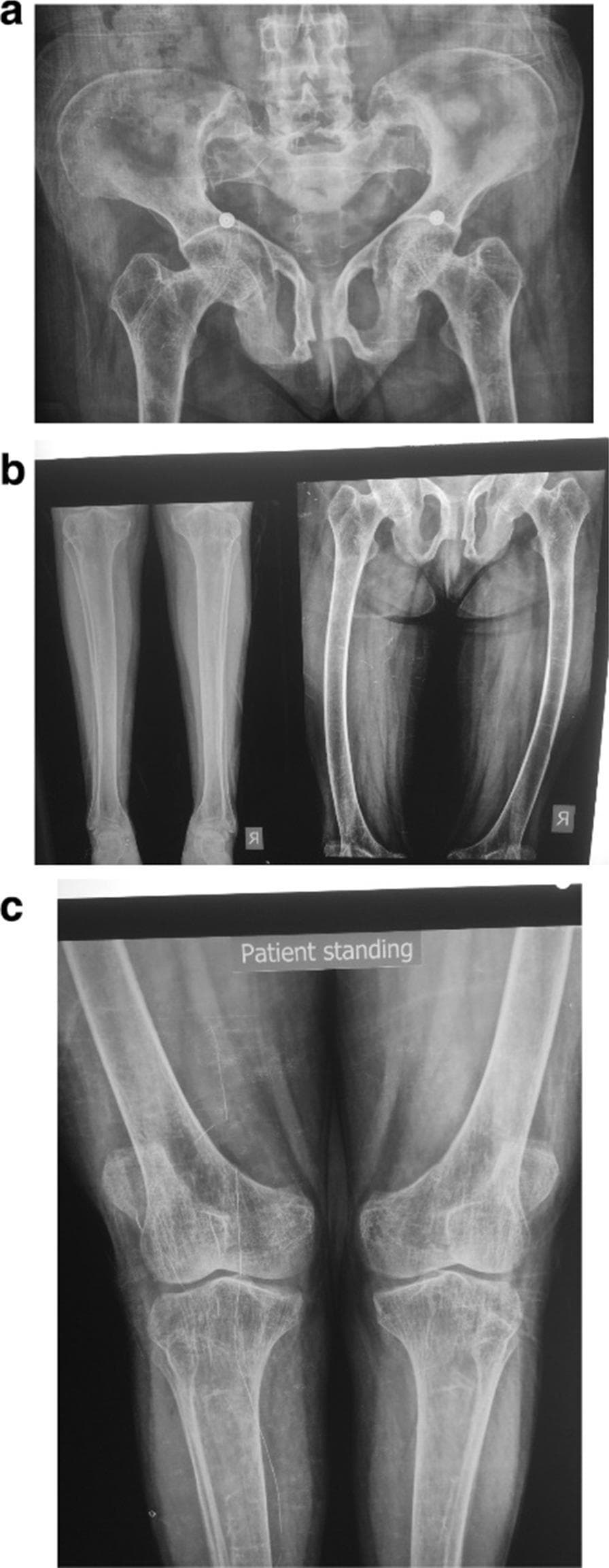 This composite diagnostic image comprises three sets of skeletal radiographs (a, b, and c) demonstrating manifestations of metabolic bone disease, consistent with Vitamin D resistant rickets.
Image (a) displays an anteroposterior (AP) pelvic view showing diffuse osteopenia, particularly around the hip joints. The pelvic brim, pubic bones, and acetabular fossa exhibit abnormal, softened morphologies, though the hip joint spaces remain preserved.
Image (b) consists of leg radiographs showing significant lateral bowing of the bilateral femoral shafts (bowing deformity) and mild osteopenia most prominent at the ankle joints.
Image (c) provides a detailed AP view of the knees while standing, revealing bilateral genu valgus (knock-knee) deformity and prominent femoral epicondyles. There is notable periarticular osteopenia around the knee joints.
The collection illustrates characteristic skeletal complications of chronic mineral deficiency, including bowing of weight-bearing long bones and structural pelvic remodeling, making it a key educational tool for identifying radiological signs of metabolic rickets and osteomalacia in a clinical context.
