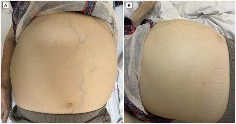 Two clinical photographs (A and B) show significant abdominal distension in a patient with massive splenomegaly. Image A, a frontal view, displays a globally distended abdomen with prominent caput medusae (engorged superficial veins) and visible striae in the lower quadrants. The patient's left upper extremity is visible, demonstrating marked muscle wasting consistent with cachexia, along with irregular, patchy purpura or skin hemorrhages. Image B provides a lateral-oblique perspective, further emphasizing the degree of abdominal protrusion and skin tension. These findings collectively illustrate the physical manifestations of chronic liver or hematological disease, specifically showing signs of portal hypertension and systemic nutritional depletion. Key educational concepts include the identification of splenomegaly-related distension, recognition of muscle wasting in chronic illness, and the visual assessment of vascular abnormalities on the abdominal wall.