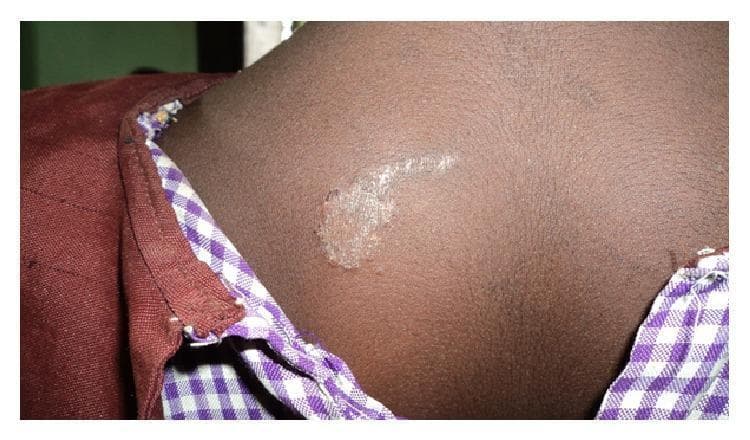Clinical photograph of a skin lesion on the upper back of a pediatric patient with a dark skin tone, consistent with Tinea corporis (ringworm). The image demonstrates a hypopigmented, well-circumscribed patch with an irregular, slightly raised, and scaly border. Centrally, the lesion shows characteristic clearing but maintains a whitish, fine-textured scaling. A linear extension of the scaling is visible, trailing away from the primary circular focus. This presentation illustrates a common superficial fungal infection (dermatophytosis) of the glabrous skin. The anatomical location is the posterior trunk near the right scapular region. The visual features are diagnostic of a fungal etiology, highlighting the annular morphology and peripheral scale distribution typically seen in localized tinea infections.