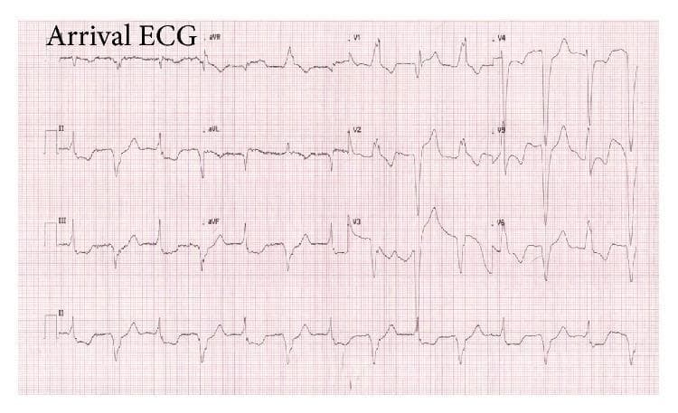 This diagnostic image is a 12-lead electrocardiogram (ECG) demonstrating atrial fibrillation with a unique pattern of alternating QRS morphologies. The rhythm is irregularly irregular with absent P-waves. The QRS complexes alternate beat-to-beat between a right bundle branch block (RBBB) pattern (characterized by an rSR' pattern in V1) and a left bundle branch block (LBBB) pattern (characterized by broad, notched R-waves in lateral leads). Significant ST-segment changes are visible: ST-segment elevation is present in the precordial leads V2-V3 and high lateral leads I and aVL, accompanied by reciprocal ST-segment depression in the inferior leads II, III, and aVF. Notably, in the LBBB-pattern beats, concordant ST-segment elevation is seen in leads V4 and V5, while discordant ST-segment changes are noted in V2-V3 and the inferior leads, satisfying Sgarbossa criteria for acute myocardial infarction. This tracing illustrates a complex presentation of infranodal conduction disease and concurrent myocardial injury in the setting of atrial fibrillation.