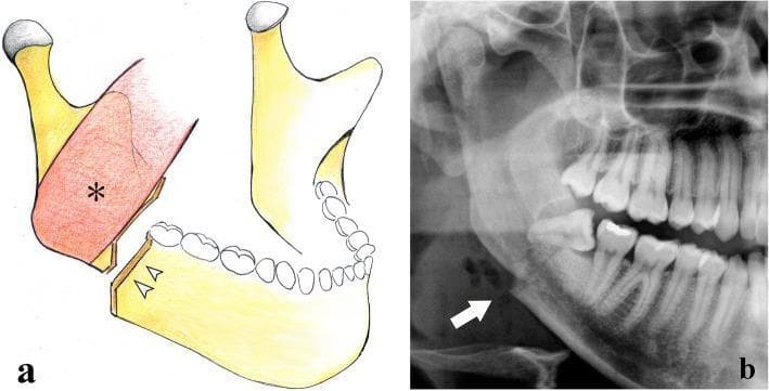 This composite educational image illustrates a mandibular angle fracture through an anatomical diagram (a) and a cropped panoramic radiograph (b). Panel (a) shows an anatomical illustration of a vertical, unfavorable fracture located distal to the third molar. The diagram demonstrates significant displacement of the distal bone fragment (ramus and condyle), which is pulled superiorly and medially by the masseter muscle (indicated by an asterisk). Panel (b) provides clinical correlation via an X-ray (orthopantomogram) showing a radiolucent fracture line through the mandibular angle. An impacted third molar is visible at the site of the fracture (indicated by an arrow), representing a common predisposing factor for fractures in this region due to localized bone weakening. The content focuses on the pathophysiology and radiographic presentation of maxillofacial trauma, specifically highlighting how muscular forces contribute to fragment displacement in mandibular angle injuries.