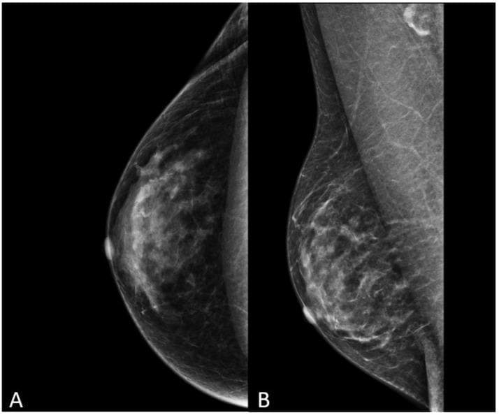 This diagnostic image displays two mammographic projections of the left breast: (A) the Cranio-Caudal (CC) view and (B) the Medio-Lateral Oblique (MLO) view. The clinical context involves a 52-year-old transgender woman following 5 years of feminizing hormone therapy. The mammogram reveals a diffuse, radio-opaque fibroglandular tissue pattern, which is more concentrated in the retroareolar and central regions and extends towards the axilla in the MLO view. This appearance mimics the typical parenchyma of a biological female breast, a result of estrogen-induced ductal and stromal development. No suspicious spiculated masses, architectural distortions, or clustered microcalcifications are identified. Small, well-defined oval densities near the skin surface may represent benign findings such as epidermal cysts or small intramammary lymph nodes. The pectoral muscle is visible in the MLO view, and the nipple is seen in profile in both projections. This image illustrates the expected physiological changes in breast tissue composition following long-term gender-affirming hormone therapy.