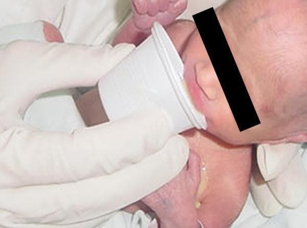 This clinical photograph demonstrates the alternative neonatal feeding method known as cup feeding. A caregiver, wearing white protective gloves, holds a small, white plastic medicine-style cup to the lips of an infant. The infant's identity is anonymized with a black bar over the eyes. The image captures the moment liquid (breast milk or formula) makes contact with the infant's lower lip, facilitating lapping or sipping movements rather than active suction used in bottle feeding. Visible fluid is noted trickling from the corner of the mouth onto the infant's chest, a common finding during the learning phase of this technique. The clinical context involves assessing masseter muscle electromyographic (EMG) activity post-electrode removal to compare oral motor patterns between breastfeeding, bottle feeding, and cup feeding. This image serves as an educational resource for neonatal nutrition, showing the proper positioning of the cup and the physical interaction between the caregiver and the neonate in a clinical or research setting.