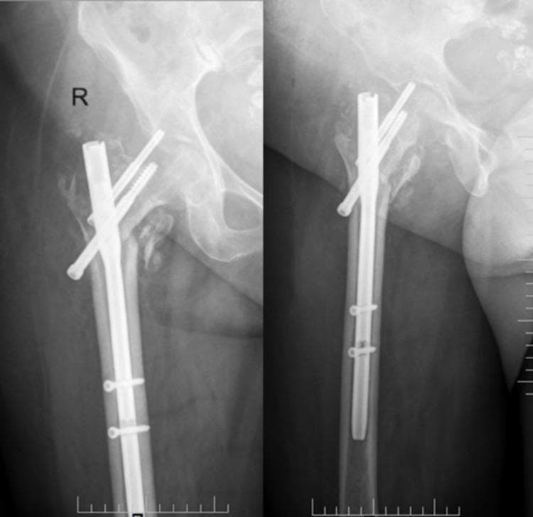 This diagnostic X-ray image demonstrates an anteroposterior (AP) and lateral view of a right proximal femur following internal fixation of an intertrochanteric fracture with a proximal femoral nail (PFN). The orthopedic hardware consists of a metallic intramedullary nail with distal locking screws and two cephalocervical screws extending through the femoral neck into the head. The AP view clearly illustrates a mechanical complication known as the 'Z-effect.' This phenomenon is characterized by the differential migration of the two proximal screws in opposite directions: the superior (stabilizing) screw has migrated medially and penetrated the hip joint space, while the inferior (lag) screw has migrated laterally through the nail. The lateral view confirms the intramedullary position of the main nail and the abnormal orientation of the cephalic screws. This visual is a classic educational example of hardware failure and implant instability in geriatric fracture management, typically resulting from poor bone quality or inadequate fracture reduction.