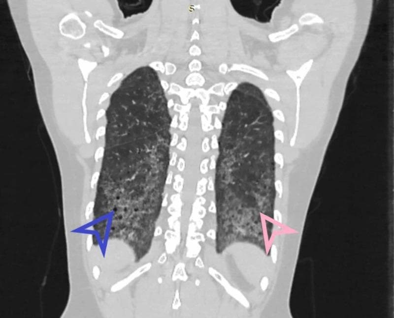 This diagnostic image is a coronal High-Resolution Computed Tomography (HRCT) scan of the chest, focusing on the lung parenchyma. The image demonstrates classic radiological features of Usual Interstitial Pneumonia (UIP), characterized by a marked basal and peripheral predominance of interstitial lung disease. Key findings include honeycombing, indicated by a blue arrowhead in the left lower lobe, appearing as clustered, thick-walled subpleural cystic airspaces. Fibrosis is also highlighted by a pink arrowhead in the right lower lobe, manifesting as reticular opacities and architectural distortion. The distribution is bilateral and symmetric, with the most severe changes occurring at the lung bases. This visual representation is essential for the diagnosis of chronic fibrosing interstitial pneumonias and illustrates the hallmark features used to differentiate UIP from other patterns like Nonspecific Interstitial Pneumonia (NSIP).