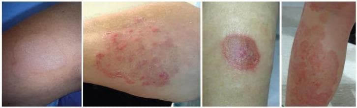 This composite of clinical photographs illustrates various clinical presentations of tinea corporis, a common dermatophyte fungal infection. The images depict the characteristic morphology of 'ringworm' across different skin areas. Key diagnostic features visible include well-demarcated, erythematous, annular (ring-shaped) patches and plaques. Several lesions demonstrate classic central clearing, where the center of the ring appears less inflamed than the periphery. The advancing borders are notably active, exhibiting varying degrees of elevation and fine scaling. The presentation varies from discrete, solitary circular lesions to larger, confluent, and irregularly shaped polycyclic patterns. The color intensity ranges from faint pink to vivid red, representing different stages of inflammatory response. These visual characteristics are essential for distinguishing tinea corporis from other annular dermatoses such as nummular eczema, granuloma annulare, or subacute cutaneous lupus erythematosus. The collection serves as an educational tool for identifying the hallmark features of cutaneous fungal infections in a clinical setting.