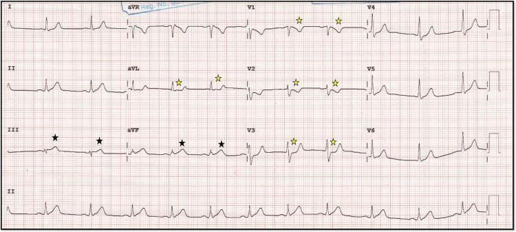 A 12-lead electrocardiogram (ECG) demonstrating signs of an acute inferior wall myocardial infarction (MI). The tracing reveals subtle ST-segment elevation and hyperacute T waves in the inferior leads (III and aVF), marked with black stars. Notably, the T-wave amplitude in lead III is disproportionately large compared to the preceding R-wave. Reciprocal changes are evident as ST-segment depression in the high lateral lead (aVL) and anterior precordial leads (V1, V2, and V3), indicated by yellow stars. Lead V2 also shows T-wave inversion. These findings are clinically significant for identifying early ischemic changes or transmural myocardial injury in the territory typically supplied by the right coronary artery (RCA). The ECG features a standard layout on grid paper with a rhythm strip at the bottom, suitable for medical education on ECG interpretation and ST-elevation myocardial infarction (STEMI) patterns.
