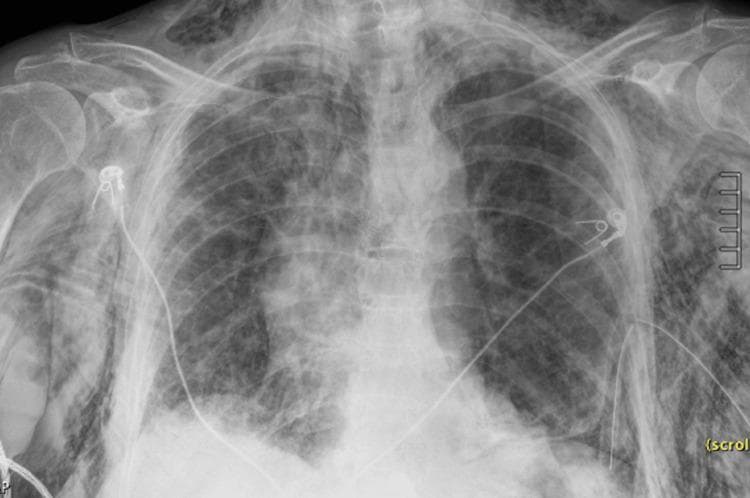 Anteroposterior (AP) chest X-ray demonstrating severe multi-compartmental air leaks. Extensive subcutaneous emphysema is visible as diffuse, streaky radiolucencies (dark areas) dissecting through the soft tissues of the chest wall, axillae, neck, and upper arms, creating a characteristic 'gingko leaf' appearance over the pectoral regions. A prominent pneumomediastinum is indicated by thin lucent lines outlining the mediastinal borders and a 'continuous diaphragm sign,' where air trapped behind the pericardium allows for visualization of the diaphragm across the midline. A left basilar pneumothorax is present, associated with a malpositioned left-sided thoracostomy tube showing a visible sentinel hole near the lateral chest wall, suggesting partial retraction. These findings illustrate critical complications of thoracic trauma or barotrauma, emphasizing the radiological manifestations of extra-alveolar air in pulmonary pathology and emergency medicine.