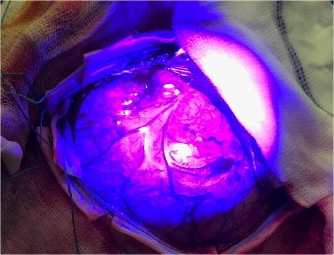This clinical intraoperative photograph demonstrates the application of 5-aminolevulinic acid (5-ALA) fluorescence-guided surgery during the resection of a superficial glioblastoma. The image shows an exposed cerebral cortical surface viewed through a specialized operating microscope filter. A distinct region of bright pink fluorescence is visible, indicating the presence of malignant glioma cells where 5-ALA has been metabolized into fluorescent porphyrins. In contrast, the surrounding healthy brain parenchyma appears dark blue, providing high-contrast visual differentiation between neoplastic and normal tissue. Within the surgical field, surface vascular structures are visible as dark, branching lines traversing both the fluorescent and non-fluorescent regions. Surgical gauze and drapes are visible at the periphery of the craniotomy site. This imaging modality is utilized by neurosurgeons to achieve maximal cytoreduction and improve the extent of resection (EOR) by highlighting infiltrative tumor margins that may appear normal under standard white-light illumination.