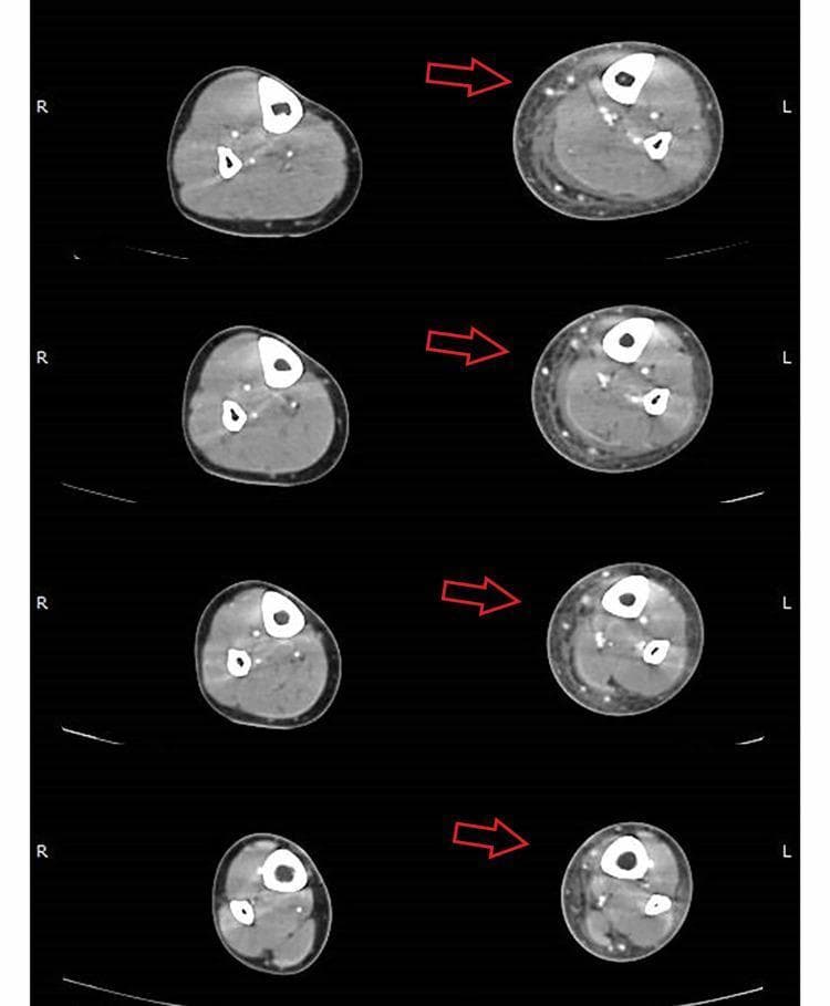 Arterial-phase axial computed tomography (CT) images of the bilateral lower legs demonstrate significant soft tissue pathology on the left side compared to the normal right side. The images show diffuse, circumferential edema of the subcutaneous tissue, characterized by increased thickness and decreased density. Key diagnostic features highlighted by red arrows include thickening of the crural fascia and a localized fluid flap (low-density collection) located on the medial aspect of the leg, adjacent to the gastrocnemius muscle belly. The transverse sections clearly delineate the tibia and fibula, allowing for comparison of the deep compartment and fascial planes. These radiological findings are highly characteristic of a severe necrotizing soft tissue infection (NSTI) or phlegmonous cellulitis, illustrating the progression of infection along fascial boundaries. This diagnostic image is intended for educational use in emergency medicine, radiology, and infectious disease specialties to aid in the identification of fascial plane involvement and subcutaneous fluid collections.