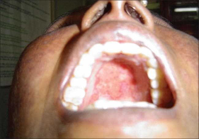 This clinical intraoral photograph displays the hard and soft palate of a patient, showing significant mucosal pathology. The image reveals multiple, scattered erythematous ulcers and erosions localized to the palatal mucosa. These lesions are characterized by a red, inflamed base with irregular borders; some appear to be coalescing into larger patches. The surrounding palatal tissue shows signs of diffuse inflammation and disruption of the normal smooth texture. Such findings are a key clinical manifestation of Systemic Lupus Erythematosus (SLE), where painless oral ulcers often serve as a non-specific but important diagnostic criterion. The photograph provides a clear educational example of autoimmune-related mucosal damage, useful for medical students and clinicians in identifying oral signs of systemic connective tissue diseases. The dental arches and teeth are visible and appear largely unaffected by the primary pathology.