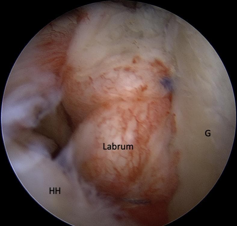 This diagnostic image is an intra-articular arthroscopic photograph of a left shoulder joint, captured from the posterior viewing portal. The image demonstrates the final result of a standard Bankart repair, an orthopedic procedure used to treat anterior shoulder instability. The primary anatomical structures are labeled: the glenoid (G) on the right and the humeral head (HH) in the lower-left. The labrum, specifically the fibrocartilaginous rim, is visible and labeled in the center, appearing re-attached and tensioned against the glenoid rim. Three suture anchors are strategically placed along the anterior-inferior glenoid rim at approximately the 7, 8, and 9 o'clock positions. The educational focus is the visual confirmation of the 'labral bumper effect' and the tensioning of the capsuloligamentous structures. This clinical imaging illustrates surgical management for recurrent shoulder dislocation and labral tears within the field of sports medicine and orthopedic surgery.