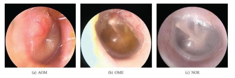 This clinical comparison image, captured via otoscopy/endoscopy, presents three distinct diagnostic states of the tympanic membrane (TM) to illustrate otitis media classification. Image (a) depicts Acute Otitis Media (AOM), characterized by a significantly erythematous, opaque, and bulging TM, which obscures the malleus and other anatomical landmarks. Image (b) shows Otitis Media with Effusion (OME), demonstrating a semi-opaque TM with an amber-colored fluid level or sterile effusion behind it; the membrane is less inflamed than in AOM but lacks normal translucency. Image (c) represents No Effusion (NOE), displaying a healthy, translucent, pearly-gray TM with clearly visible anatomical landmarks, including the lateral process and handle of the malleus. This visual aid serves as a diagnostic tool for distinguishing bacterial infection (AOM) from sterile fluid collection (OME) and normal middle ear status (NOE) based on variations in color, position (bulging vs. neutral), and opacification. Educational focus includes otolaryngology physical examination findings and the clinical signs of middle ear inflammation.