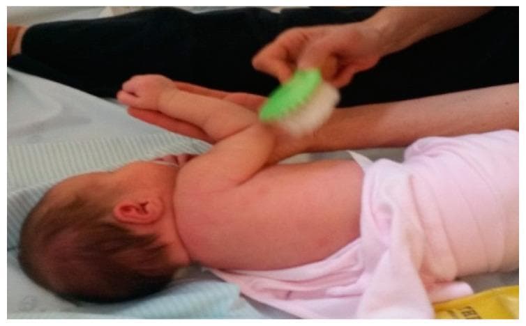 This clinical photograph illustrates a sensory stimulation technique used in neonatal rehabilitation, specifically for managing Neonatal Brachial Plexus Palsy (NBPP). The image depicts an infant lying in a lateral decubitus position on a padded surface. An adult caregiver or therapist is performing tactile and proprioceptive stimulation on the infant's affected upper limb. One hand stabilizes the infant's distal arm and hand in an elevated position, while the other hand applies a soft-bristled brush to the skin of the upper arm and shoulder region. This therapeutic intervention aims to provide varied sensorimotor input, promote central integration of the injured limb, and increase the infant's sensory perception of the arm. The use of different textures, such as the brush shown, is a key component of an early occupational therapy program designed to prevent sensory neglect and support the functional recovery of affected nerves following birth-related brachial plexus injury.