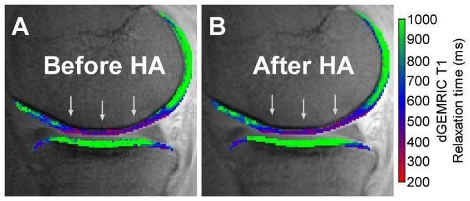 This diagnostic image displays a comparison of delayed Gadolinium-Enhanced Magnetic Resonance Imaging of Cartilage (dGEMRIC) color maps in a sagittal view of the knee joint. The panels illustrate the medial tibiofemoral compartment 'Before HA' (A) and 'After HA' (B), assessing the effect of hyaluronic acid viscosupplementation on cartilage composition. The color overlay represents T1 relaxation times in milliseconds (ms), which serves as a surrogate marker for sulfated glycosaminoglycan (sGAG) content. The color scale ranges from 200 ms (red/purple, indicating low sGAG) to 1000 ms (bright green, indicating high sGAG). In both images, grey arrows highlight a region of the weight-bearing femoral cartilage (wbFC) characterized by blue and red hues, signifying lower T1 relaxation times and depleted sGAG content typical of early-stage osteoarthritis. Conversely, the weight-bearing tibial plateau (wbTP) displays green coloration, suggesting higher sGAG retention. Comparing panels A and B reveals no visually significant change in the T1 relaxation maps following HA injection, indicating that while clinical symptoms might improve, the biochemical composition of the cartilage remains stable.