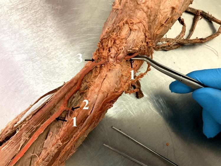 This clinical photograph displays a cadaveric dissection of a human right upper limb, focusing on an anatomical variation of the arterial supply in the forearm. The primary structure highlighted is a brachioradial artery (labeled '1'), which is shown being manipulated by surgical forceps at its proximal origin. The artery follows a superficial course along the anterior compartment of the forearm. During its descent, it gives off a small muscular branch (labeled '2'). Distally, near the wrist region, the vessel bifurcates into two distinct terminal branches (labeled '3'), which correspond to the ramus carpalis palmaris and the ramus palmaris superficialis. This image is an educational tool for gross anatomy and vascular surgery, illustrating a high-origin radial artery variation where the vessel arises from the brachial artery and descends superficially to the median nerve. Such variations are clinically significant for arterial cannulation, flap harvesting, and avoiding iatrogenic injury during orthopedic or plastic surgery procedures in the forearm and hand.