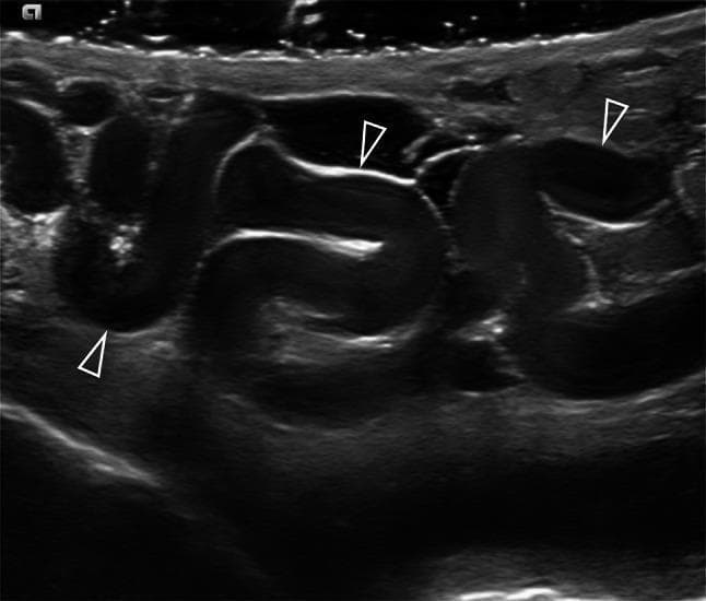 This diagnostic grayscale ultrasound image displays the classic sonographic findings of a varicocele within the pampiniform plexus of the scrotum. The image reveals multiple, markedly dilated and serpiginous (tortuous) venous structures, indicated by white arrowheads. These vessels are hypoechoic compared to the surrounding soft tissue and measure larger than the typical 3 mm diagnostic threshold. Within the lumen of the dilated veins, low-level internal echoes are visible, which may represent slow-moving blood flow (spontaneous contrast) or altered blood dynamics characteristic of venous insufficiency and reflux. The image demonstrates the structural abnormalities of the spermatic cord veins, providing a key educational example of urological diagnostic imaging for male infertility and scrotal pathology. This modality is essential for differentiating clinical and subclinical varicoceles by assessing morphology, diameter, and internal echogenicity before proceeding to Doppler analysis.