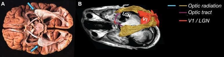This dual-panel image provides a comparative view of the visual pathway's white matter tracts through anatomical dissection and neuroimaging. Panel A shows a postmortem gross dissection of a human brain from an inferior-lateral perspective. It highlights the optic radiation (OR) as prominent, fan-shaped white fibrous bundles. Blue arrows specifically denote Meyer's loop, the anterior-most extension of the optic radiation that curves around the temporal horn of the lateral ventricle. Panel B presents an in vivo diagnostic representation using 3D tractography overlaid on an axial MRI slice. The visual pathway is color-coded for educational clarity: the optic chiasm (OC) is visible anteriorly; the optic tracts are shown in purple extending toward the lateral geniculate nucleus (LGN); the optic radiations are pseudo-colored in gold, demonstrating their projection toward the primary visual cortex (V1), which is highlighted in red in the occipital lobe. The image serves as an educational tool for neuroanatomy, neuro-ophthalmology, and radiology to illustrate the complex spatial trajectory of axons carrying visual information from the diencephalon to the cortex.