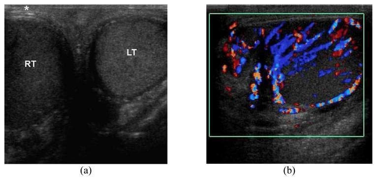 This diagnostic ultrasound display consists of two panels illustrating the clinical features of acute epididymo-orchitis in a 45-year-old male. Panel (a) is a transverse grayscale ultrasound of the scrotum providing a side-by-side comparison of the testes. The right testis (RT) is markedly enlarged and demonstrates a diffuse hypoechoic echotexture compared to the normal left testis (LT). Additionally, the overlying right scrotal skin is significantly thickened, indicated by an asterisk. Panel (b) shows a longitudinal color Doppler ultrasound (CDUS) of the right hemiscrotum. This image reveals prominent hypervascularity within both the testis and the adjacent epididymis, characterized by dense red and blue signals representing increased blood flow (hyperemia). These visual findings—testicular enlargement, decreased echogenicity, skin thickening, and hyperperfusion—are classic diagnostic indicators for infectious or inflammatory processes of the scrotum, distinguishing epididymo-orchitis from testicular torsion where flow would be absent.