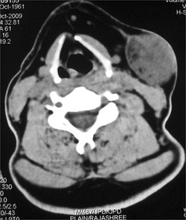 This diagnostic image is an axial computed tomography (CT) scan of the neck at the level of the cervical spine and larynx. The scan demonstrates a prominent, well-circumscribed soft tissue mass measuring approximately 3.2 x 4.2 cm in the left submandibular/parotid region. The lesion is primarily composed of soft tissue density with scattered internal hypodensities consistent with fat attenuation, particularly visible at the periphery. Anatomically, the mass is located lateral to the superficial lobe of the left parotid gland and extends anteriorly to the sternocleidomastoid muscle. The lesion exerts a significant mass effect, resulting in the outward displacement of the overlying platysma muscle and subcutaneous tissues. The internal architecture appears heterogeneous, which is a key clinical finding for differential diagnosis of parotid gland or soft tissue tumors such as pleomorphic adenoma or liposarcoma. This educational material is suitable for radiology and head and neck surgery students to study the spatial relationships and CT attenuation characteristics of cervical soft tissue lesions.