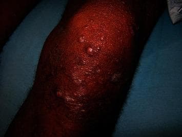 This clinical photograph displays a representative skin lesion characteristic of lepromatous leprosy (LL). The image shows a limb, likely the knee or elbow area, exhibiting diffuse cutaneous thickening. Numerous discrete, erythematous to skin-colored nodules of varying sizes are scattered across the affected surface. These papulonodular lesions demonstrate a tendency toward confluence, forming larger, irregular patches of infiltrated skin. The skin texture appears coarse and indurated, reflecting the high bacillary load and extensive dermal infiltration typical of the polar lepromatous end of the Ridley-Jopling classification. This visual serves as an educational example of the symmetrical, multifocal nodular distribution seen in advanced Mycobacterium leprae infections, highlighting the difference between the paucibacillary tuberculoid form and this multibacillary presentation.