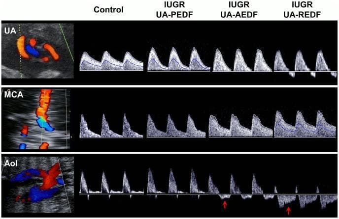 This diagnostic ultrasound comparison chart illustrates fetal Doppler spectral waveforms in the assessment of intrauterine growth restriction (IUGR). The image displays a matrix of flow velocity waveforms across three fetal vessels: the umbilical artery (UA), middle cerebral artery (MCA), and aortic isthmus (AoI). Four clinical states are compared: a normal Control fetus and three progressive stages of IUGR: Present End-Diastolic Flow (PEDF), Absent End-Diastolic Flow (AEDF), and Reversed End-Diastolic Flow (REDF). Key diagnostic features include: 1) UA progression from high-diastolic flow in the control to complete loss (AEDF) and reversal (REDF) of flow during diastole, indicating increased placental resistance. 2) MCA changes showing the 'brain-sparing effect,' where diastolic flow increases as IUGR severity progresses. 3) AoI waveforms demonstrating increasingly pathological retrograde flow during late systole and diastole, highlighted by red arrows in the AEDF and REDF cases. This visual resource is critical for teaching fetal hemodynamics, placental insufficiency, and the criteria for identifying severe fetal distress in obstetric radiology.