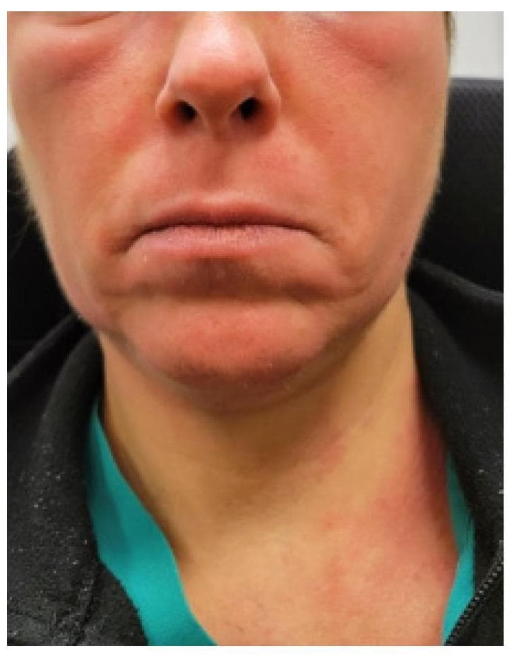 Clinical photograph of a patient's face and neck demonstrating significant cutaneous manifestations of a systemic inflammatory or allergic process. The image shows diffuse, confluent erythema (flushing) most prominent on the cheeks, bridge of the nose, and forehead. Notable periorbital edema is present, manifesting as puffiness and swelling around the eyes. The erythema extends inferiorly to the neck and upper chest area in a patchy, macular distribution. While the inflammatory process is diffuse, the perioral region appears relatively spared compared to the malar and periorbital areas. The skin surface exhibits a slight sheen, suggestive of underlying edema or acute inflammation. This presentation is clinically significant for the evaluation of Mast Cell Activation Syndrome (MCAS), chronic urticaria, angioedema, or autoimmune connective tissue diseases like dermatomyositis (heliotrope rash/malar rash). The image serves as a teaching aid for identifying facial flushing and soft tissue swelling in the context of systemic hypersensitivity or autonomic dysfunction.