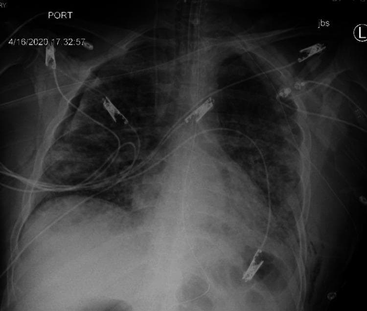 This diagnostic chest X-ray (portable, anteroposterior view) demonstrates post-procedural findings following tube thoracostomy for a pneumothorax. A right-sided chest tube is visible, entering through the axillary region and extending superiorly toward the right lung apex. Despite the tube, a residual small right apical pneumothorax is present, evidenced by a thin pleural line and absence of peripheral lung markings in the apical region. The right lung volume is slightly reduced compared to the left. The left lung remains well-inflated with visible vascular markings. Notable extracorporeal findings include multiple medical monitor leads, various catheters secured with radiopaque clips across the upper thorax and neck, and an endotracheal tube in situ, reflecting intensive care management. Bilateral, diffuse, patchy opacities are present throughout both lung fields, consistent with the patient's primary diagnosis of COVID-19 pneumonia and acute respiratory distress syndrome (ARDS).