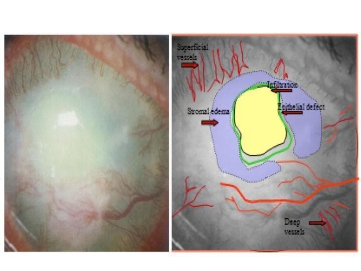 This clinical photograph and corresponding annotated diagram illustrate a comprehensive ophthalmological assessment of a corneal ulcer. The left panel shows a macro-photograph of the anterior segment of the eye, demonstrating significant corneal opacification, diffuse clouding, and prominent conjunctival and ciliary injection. The right panel provides a schematic overlay to clarify pathological features. A central yellow area demarcates a dense corneal infiltration, indicating an active infectious or inflammatory process. This is outlined by a green perimeter identifying an epithelial defect. Surrounding the infiltration is a blue-shaded zone representing stromal edema, characterized by hazy tissue thickening. The diagram also maps vascular changes using red lines to distinguish between fine superficial neovascularization and larger, deeper vessels migrating from the limbus toward the lesion. This image serves as an educational tool for identifying the clinical hallmarks of keratitis, including the spatial relationship between tissue infiltration, edema, and the compensatory vascular response.