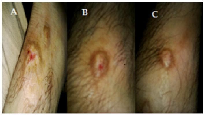 This sequence of three clinical photographs (A, B, and C) documents the progression and resolution of a Tinea corporis infection on a patient's forearm under treatment. Image A (Before treatment) shows a classic fungal skin lesion with intense central erythema, localized inflammation, and evidence of epidermal breakdown or erosion. Image B (After 1 week) demonstrates the characteristic 'ringworm' morphology, with the development of a raised, erythematous peripheral border (annular configuration) while the central redness begins to subside. Image C (After 2 weeks) shows significant healing, characterized by a marked reduction in inflammation, a more uniform skin tone, and the formation of a dry scab or resolving plaque at the primary site. The surrounding lightly pigmented skin and hair follicles remain largely unaffected throughout the timeline, illustrating the localized nature of the dermatophyte infection and the therapeutic response to the topical treatment.