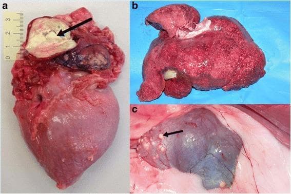 This composite of clinical gross pathology photographs displays multi-organ involvement of granulomatous inflammation consistent with Mycobacterium tuberculosis infection. Panel (a) shows a dissected heart specimen featuring a large, irregularly shaped tuberculoma (approximately 2-3 cm) in the left atrium, characterized by a yellowish-white, semi-solid, caseous necrotic core indicated by a black arrow. Panel (b) illustrates an enlarged, congested liver exhibiting a diffuse miliary pattern, with numerous small, pale foci of granulomatous inflammation scattered throughout the parenchyma. Panel (c) displays a kidney with a distorted, irregular morphology and a dark, cyanotic hue. Multiple small, white subcapsular nodules (granulomas) are visible, with a black arrow highlighting a prominent lesion. These images demonstrate the systemic manifestation of tuberculosis in internal organs, emphasizing the macroscopical features of caseous necrosis and diffuse granuloma formation in the cardiovascular, hepatic, and renal systems. This educational visual is intended for students and professionals in pathology, infectious diseases, and internal medicine to recognize gross signs of disseminated mycobacterial disease.